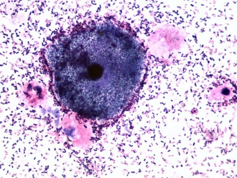 dieu-tri-viem-am-dao-do-tap-khuan (480 x 360).jpg