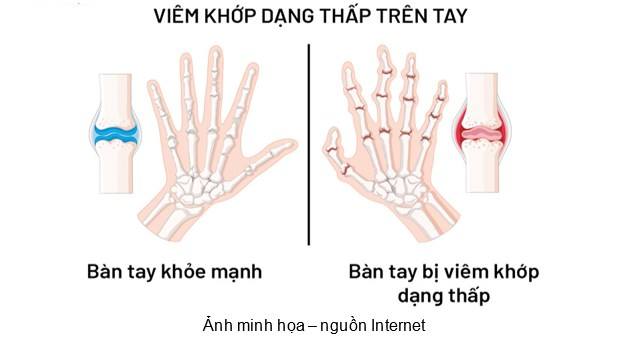 Viem-khop-dang-thap.jpg