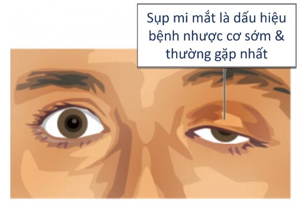 benh-nhuoc-co-mi-mat.jpg