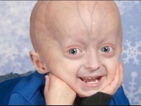 Pháp đã tìm ra hội chứng lão hóa sớm