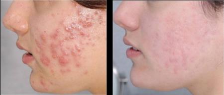 Lưu ý khi sử dụng thuốc trị mụn