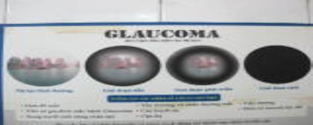 Nhỏ thuốc mắt chứa corticoid, bé 10 tuổi bị hỏng thị lực