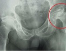 Hoại tử khớp háng khi tiêm corticoid chữa ngứa đầu