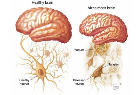 Đột phá trong chữa trị Alzheimer: thử nghiệm thành công kháng thể chữa Alzheimer trên chuột