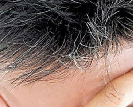 Tóc bạc khi còn trẻ có liên quan hệ miễn dịch?