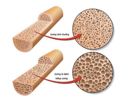 "Thuốc tiên" giá rẻ nhiều người Việt ưa dùng chữa đủ thứ bệnh: Cẩn thận ung thư, mục xương