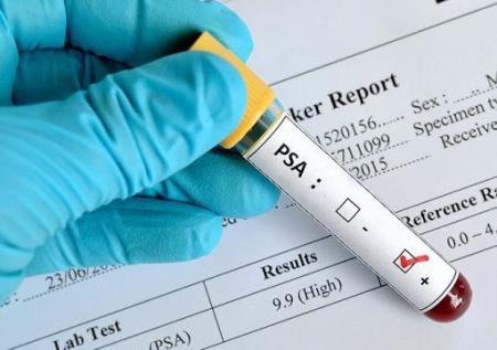 3 bệnh ung thư nam giới nhất định cần tầm soát