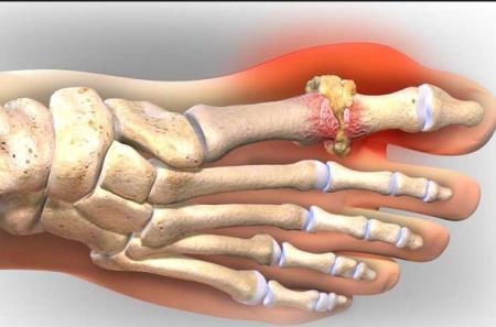 Sử dụng Allopurinol và Febuxostat trong điều trị bệnh gút