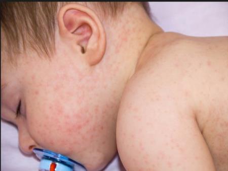 Tổ chức Y tế Thế giới coi việc từ chối tiêm vắc-xin là mối đe dọa toàn cầu trong năm 2019