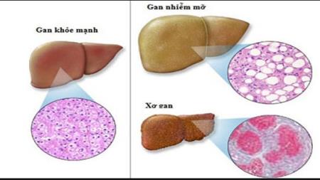 Nguyên nhân gây bệnh gan nhiễm mỡ