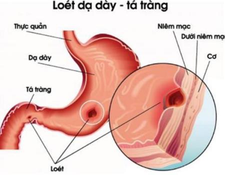 Loét dạ dày không điều trị có thể thành ung thư: Chuyên gia mách cách sống chung với bệnh