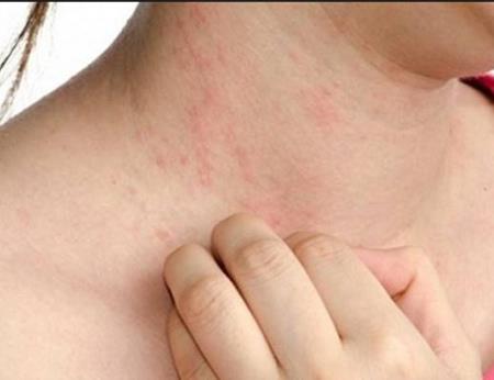 Mày đay do lạnh - Biểu hiện và cách phòng ngừa