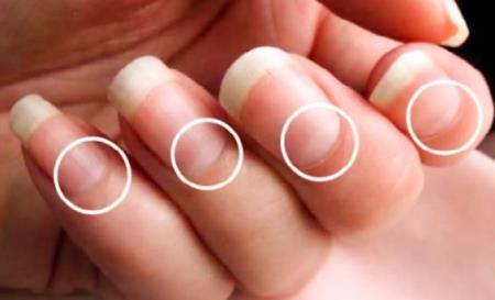 Móng tay nói lên tình trạng sức khỏe của bạn