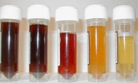 Nhìn nước tiểu đoán bệnh