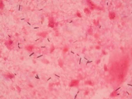 Tiêm vi khuẩn vào khối u để giết chết ung thư: Thử nghiệm cho kết quả đầy hứa hẹn