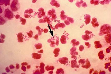 GSK thử nghiệm giai đoạn III cho thuốc Gepotidacin : kháng sinh mới trị bệnh lậu