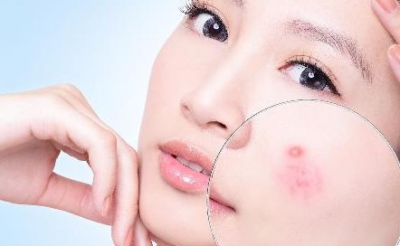 Thuốc Trifarotene: một phương pháp điều trị Retinoid mới cho mụn trứng cá