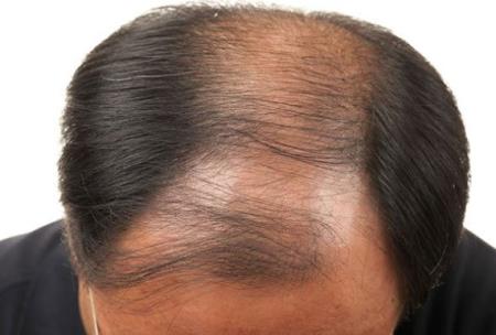 Tìm ra biện pháp dùng mùi hương để trị bệnh hói