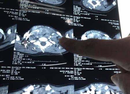 Bé trai 3 tuổi đã mắc ung thư di căn