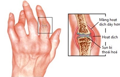Các thuốc điều trị viêm khớp dạng thấp được FDA cấp phép