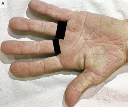 Dấu hiệu vân nhăn kỳ lạ trong lòng bàn tay thể hiện nguy cơ bệnh ung thư tiềm ẩn