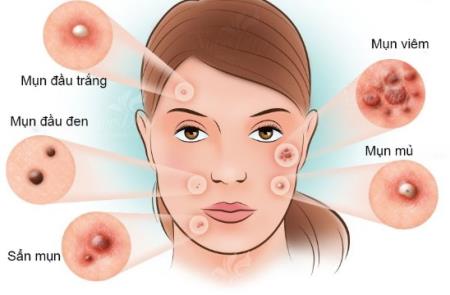Mụn trứng cá ở các vùng trên cơ thể do nguyên nhân gì