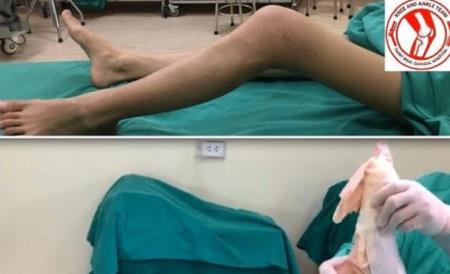 Nữ sinh 16 tuổi đã ung thư xương: Dấu hiệu chỉ là cơn đau âm ỉ dễ bỏ qua