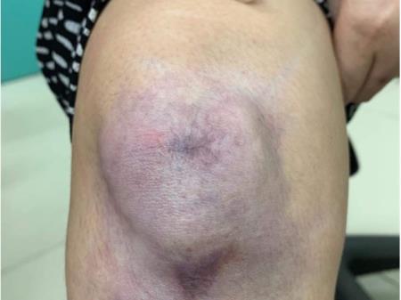 Chữa sẹo lồi tại spa: vết thương sẹo chỉ bằng đầu đũa bỗng to như bàn tay