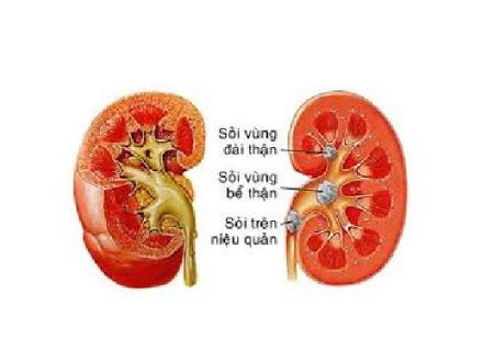 Những dấu hiệu cảnh báo ban đầu của bệnh sỏi thận