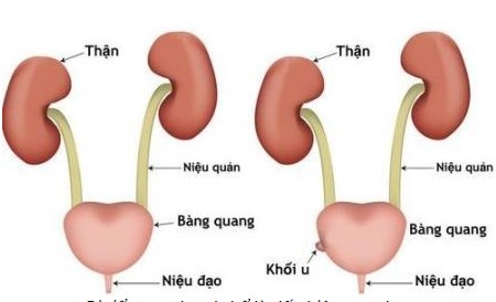 Đi tiểu ra máu hãy khám ngay vì đó có thể là dấu hiệu cảnh báo ung thư!