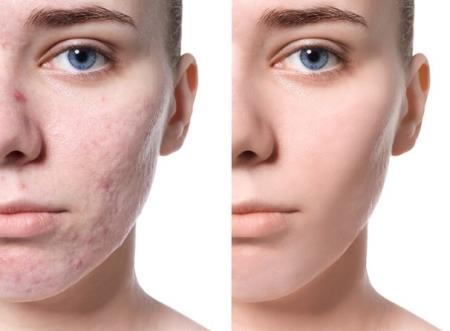 Cách trị sẹo lâu năm hiệu quả mà tiết kiệm nhất