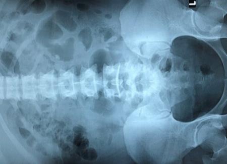 Bệnh nhân suy thận cấp vì chữa sỏi thận bằng lá thuốc không rõ nguồn gốc