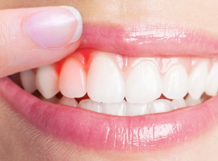 Vi khuẩn porphyromonas gingivalis trong miệng gây các bệnh ung thư, tiểu đường,Alzheimer