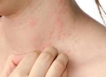 Bệnh Ghẻ và thuốc chữa