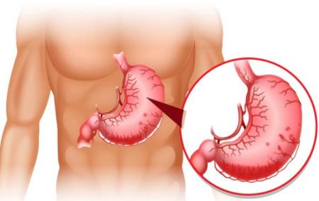Chỉ cần có 2 dấu hiệu này là vết loét dạ dày có thể đang tiến triển thành ung thư