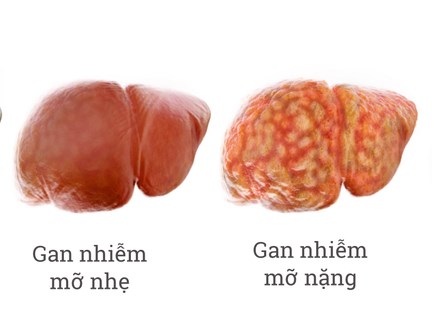 Thủ phạm gây ra các bệnh về gan nguy hiểm