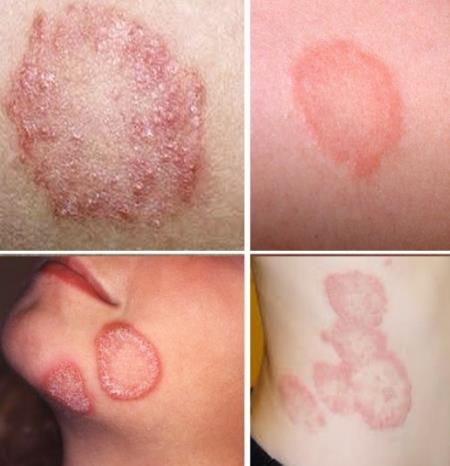 Thuốc nào điều trị bệnh hắc lào , lang ben