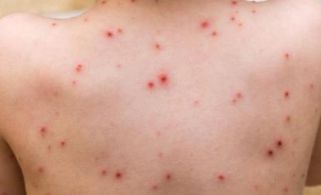 Chăm sóc bé bị thủy đậu