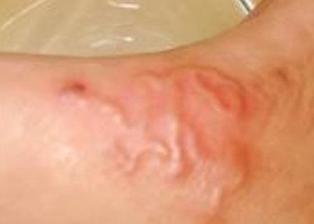 10 thắc mắc thường gặp về bệnh giun sán