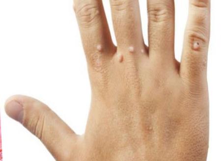 Cách chữa mụn hạt cơm