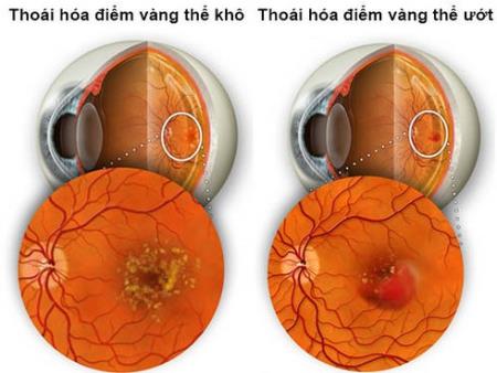 Thoái hóa điểm vàng là gì