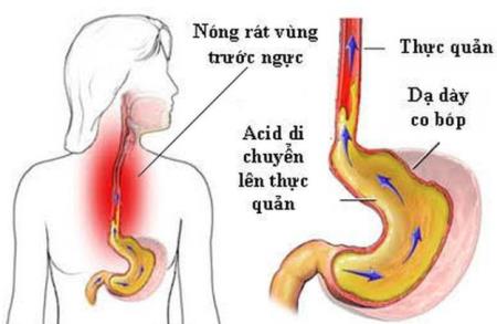 Trào ngược thực quản có thể biến chứng thành ung thư: GS tiêu hoá mách cách "sống chung"