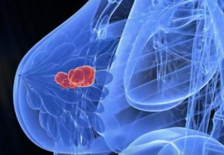 Thiếu nữ 17 phát hiện 2 khối u ở ngực, căn bệnh hơn 80% phụ nữ Việt mắc phải