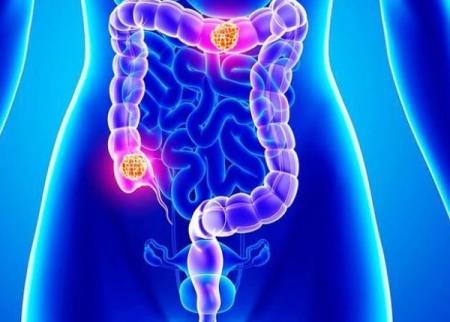 Xem tivi 2 giờ/ngày, bệnh ung thư nguy hiểm này sẽ lớn lên nhanh chóng