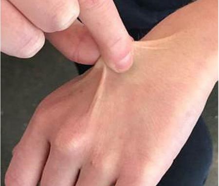 Cách tự kiểm tra cơ thể đủ nước hay thiếu nước trong mùa hè