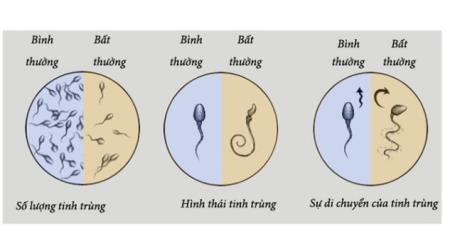 4 yếu tố có thể khiến tinh trùng bất thường, dị dạng: Mọi nam giới đều nên biết để tránh