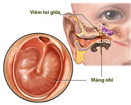 Cách chăm sóc trẻ viêm tai giữa, tránh biến chứng lên não