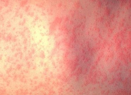 Bệnh sởi tăng cao toàn thế giới, số mắc tăng 300% do người dân không tiêm vắc xin