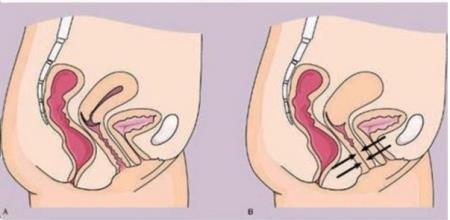 Căn bệnh khiến cặp đôi không thể quan hệ tình dục sau bao năm kết hôn