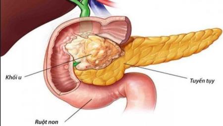 3 dấu hiệu ung thư tuyến tụy giúp phát hiện sớm
